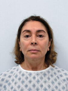 Тотальное омоложение лица - до