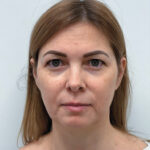 Эндоскопический лифтинг в сочетании блефаропластикой - до