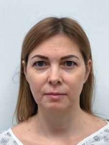 Эндоскопический лифтинг в сочетании блефаропластикой - до