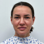 Эндоскопический лифтинг в сочетании блефаропластикой - до