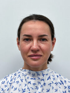 Эндоскопический лифтинг в сочетании блефаропластикой - до