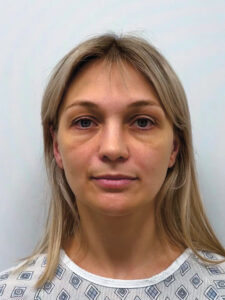 Эндоскопический лифтинг в сочетании блефаропластикой - до