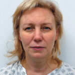 Эндоскопический лифтинг в сочетании блефаропластикой - до