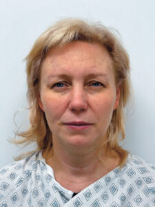 Эндоскопический лифтинг в сочетании блефаропластикой - до