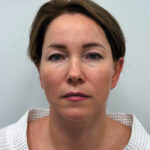 Эндоскопический лифтинг в сочетании блефаропластикой - до