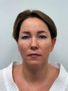 Эндоскопический лифтинг в сочетании блефаропластикой - до