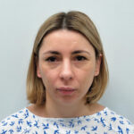 Эндоскопический лифтинг в сочетании блефаропластикой - до