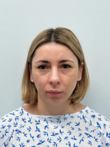 Эндоскопический лифтинг в сочетании блефаропластикой - до