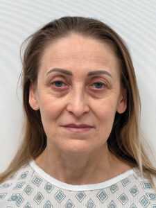 Эндоскопический лифтинг в сочетании блефаропластикой - до