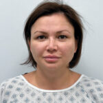 Эндоскопический лифтинг в сочетании блефаропластикой - до