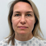 Эндоскопический лифтинг в сочетании блефаропластикой - до