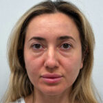 Эндоскопический лифтинг с нижней блефаропластикой - до