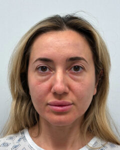 Эндоскопический лифтинг с нижней блефаропластикой - до