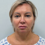 Комплексное омоложение лица - до