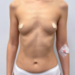 Маммопластика увеличение - до