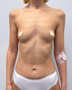 Маммопластика увеличение - до