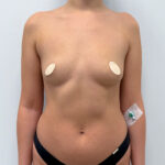 Маммопластика увеличение - до