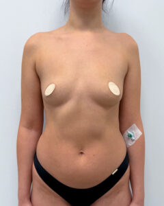 Маммопластика увеличение - до