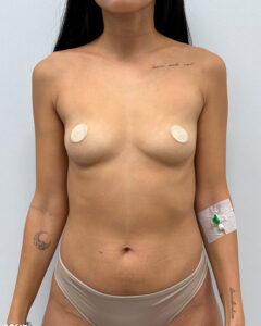 Маммопластика увеличение - до