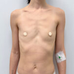 Маммопластика увеличение - до