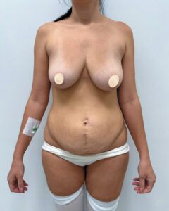 Маммопластика подтяжка - до