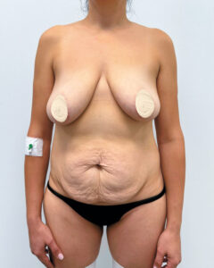 Маммопластика подтяжка - до