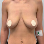 Маммопластика подтяжка - до