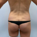 Липосакция ягодиц - до