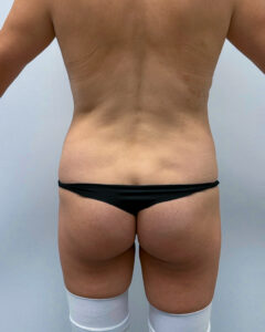 Липосакция ягодиц - до