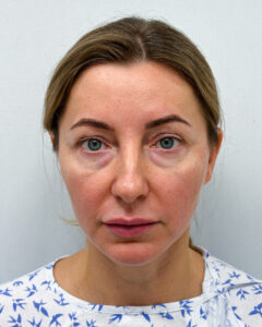 Трансконъюнктивальная блефаропластика - до