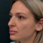 Ринопластика - до