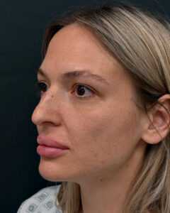 Ринопластика - до