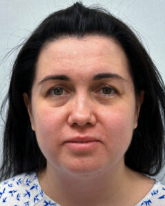 Эндоскопический лифтинг с блефаропластикой - до