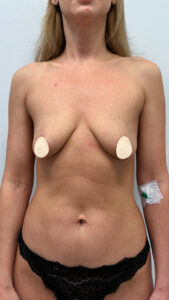 Подтяжка с увеличением - до