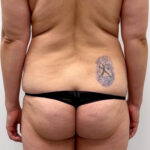 Липосакция - до