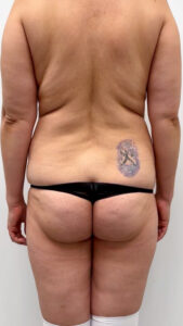 Липосакция - до