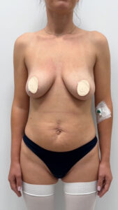 Увеличение с подтяжкой - до