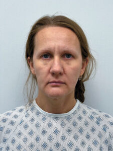 Эндоскопический лифтинг + круговая блефаропластика - до