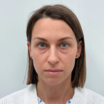 Трансконъюнктивальная блефаропластика - до