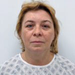 Тотальное омоложение лица - до