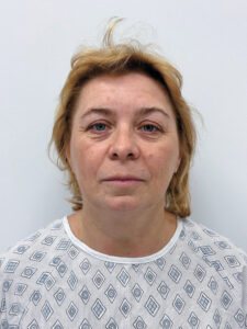 Тотальное омоложение лица - до