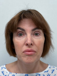 Трансконъюнктивальная блефаропластика - до