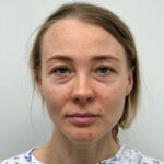 Трансконъюнктивальная блефаропластика - до