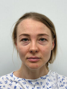 Трансконъюнктивальная блефаропластика - до