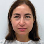 Эндоскопический лифтинг в сочетании с круговой блефаропластикой - до