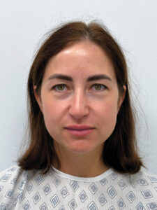 Эндоскопический лифтинг в сочетании с круговой блефаропластикой - до