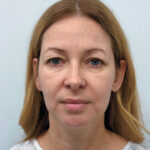 Эндоскопический лифтинг в сочетании с круговой блефаропластикой - до