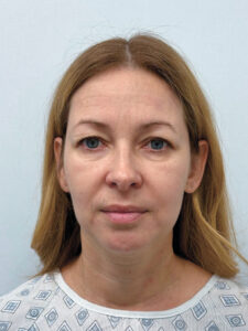 Эндоскопический лифтинг в сочетании с круговой блефаропластикой - до