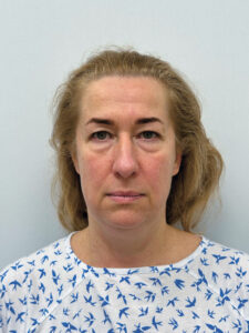 Эндоскопический лифтинг + круговая блефаропластика - до