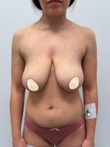 Редукционная маммопластика с подтяжкой без имплантации - до